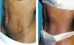 Body Procedures Patient Before & After Photo 1