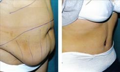 Body Procedures Patient Before & After Photo 1