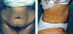 Panniculectomy Patient Before & After Photo 1