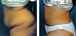 Panniculectomy Patient Before & After Photo 1