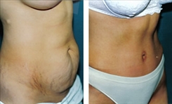 Body Procedures Patient Before & After Photo 1