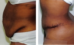 Panniculectomy Patient Before & After Photo 1