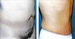 Panniculectomy Patient Before & After Photo 1