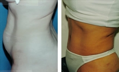 Panniculectomy Patient Before & After Photo 1