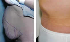 Panniculectomy Patient Before & After Photo 1