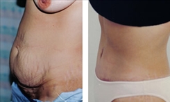 Panniculectomy Patient Before & After Photo 1