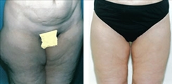 Panniculectomy Patient Before & After Photo 1