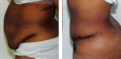 Panniculectomy Patient Before & After Photo 1