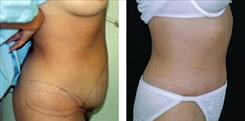 Panniculectomy Patient Before & After Photo 1