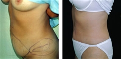 Body Procedures Patient Before & After Photo 1