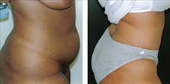 Body Procedures Patient Before & After Photo 1