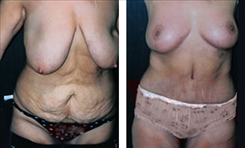 Panniculectomy Patient Before & After Photo 1