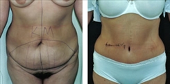 Body Procedures Patient Before & After Photo 1