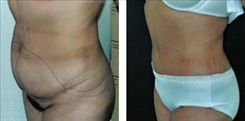 Body Procedures Patient Before & After Photo 1