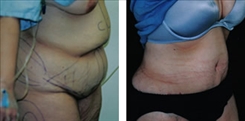 Panniculectomy Patient Before & After Photo 1