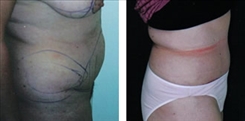 Panniculectomy Patient Before & After Photo 1