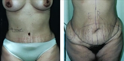 Panniculectomy Patient Before & After Photo 1