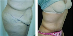 Panniculectomy Patient Before & After Photo 1