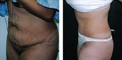 Panniculectomy Patient Before & After Photo 1