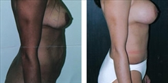 Panniculectomy Patient Before & After Photo 1