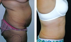 Panniculectomy Patient Before & After Photo 1