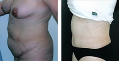 Panniculectomy Patient Before & After Photo 1