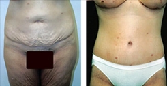 Panniculectomy Patient Before & After Photo 1