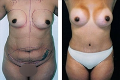 Body Procedures Patient Before & After Photo 1