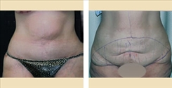 Panniculectomy Patient Before & After Photo 1