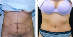 Panniculectomy Patient Before & After Photo 1