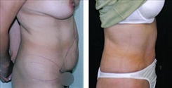 Panniculectomy Patient Before & After Photo 1