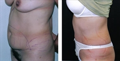 Panniculectomy Patient Before & After Photo 1