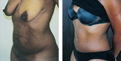 Panniculectomy Patient Before & After Photo 1