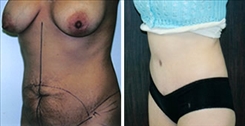 Panniculectomy Patient Before & After Photo 1