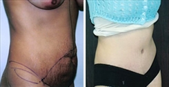 Panniculectomy Patient Before & After Photo 1