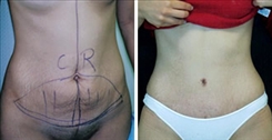 Body Procedures Patient Before & After Photo 1