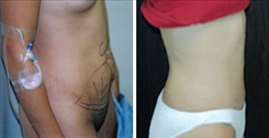 Body Procedures Patient Before & After Photo 1