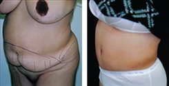 Panniculectomy Patient Before & After Photo 1
