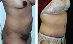 Panniculectomy Patient Before & After Photo 1