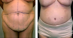 Panniculectomy Patient Before & After Photo 1