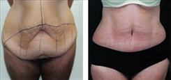 Panniculectomy Patient Before & After Photo 1