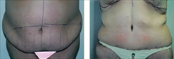 Body Procedures Patient Before & After Photo 1