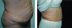 Panniculectomy Patient Before & After Photo 1