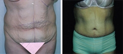 Panniculectomy Patient Before & After Photo 1