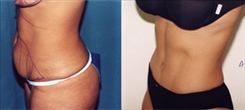 Panniculectomy Patient Before & After Photo 1