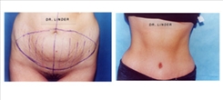 Panniculectomy Patient Before & After Photo 1