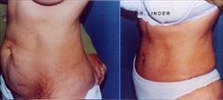 Panniculectomy Patient Before & After Photo 1