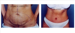 Panniculectomy Patient Before & After Photo 1