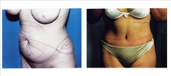 Panniculectomy Patient Before & After Photo 1