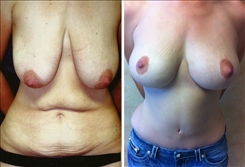 Post Bariatric Weight Loss Surgery Patient Before & After Photo 1